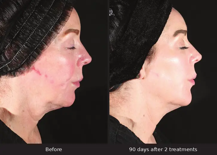 XERF before and after, jawline and neck, 90 days after 2 treatments