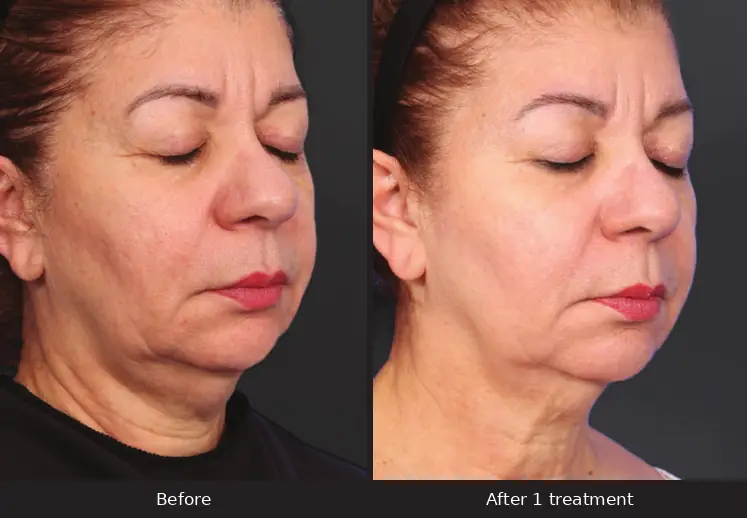 XERF before and after, face and neck, after 1 treatment