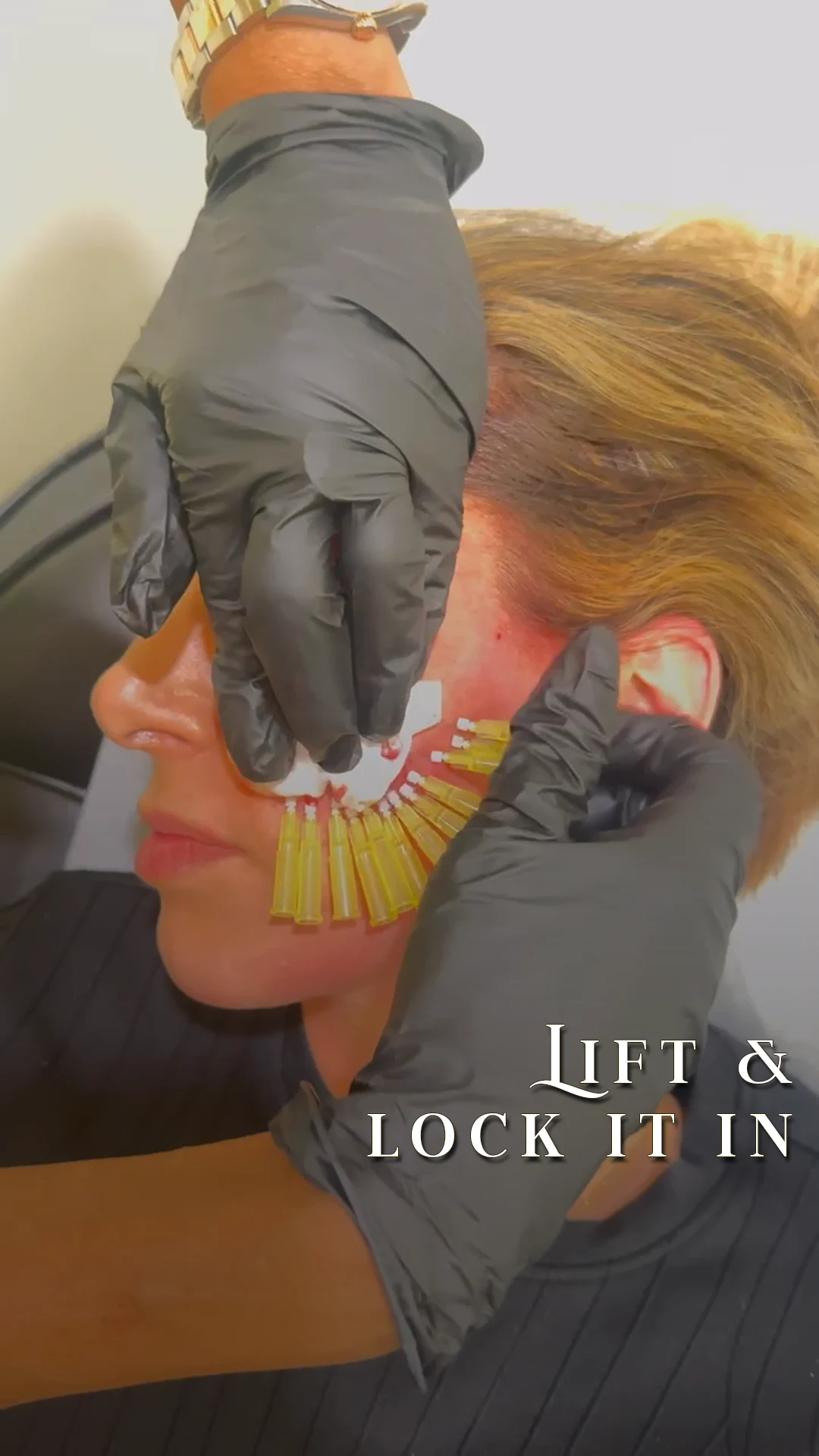 PDO thread technique demonstrated during training