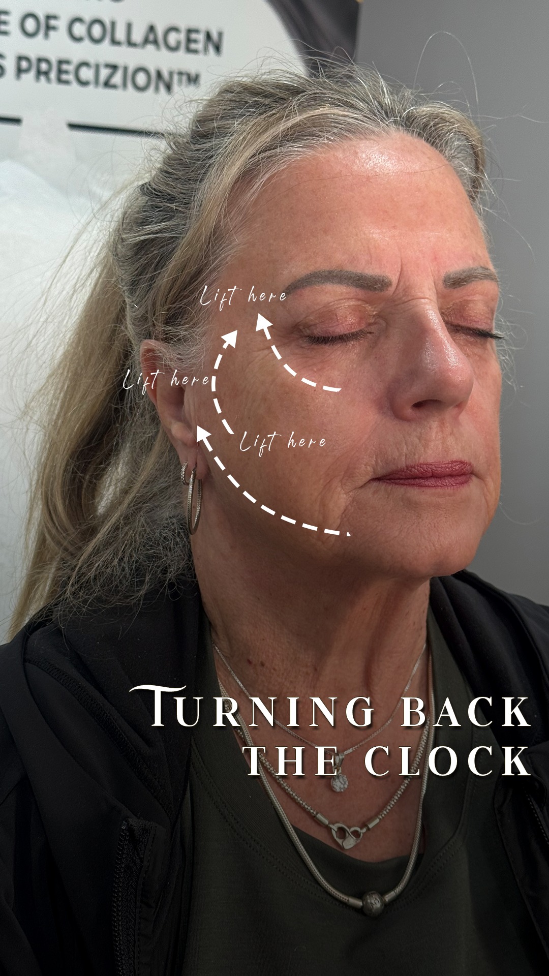 Case 045 · Mid-Face